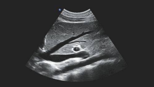 Longitudinal Liver with Inferior Vena Cava Hepatic Veins and Abdominal Aorta CC