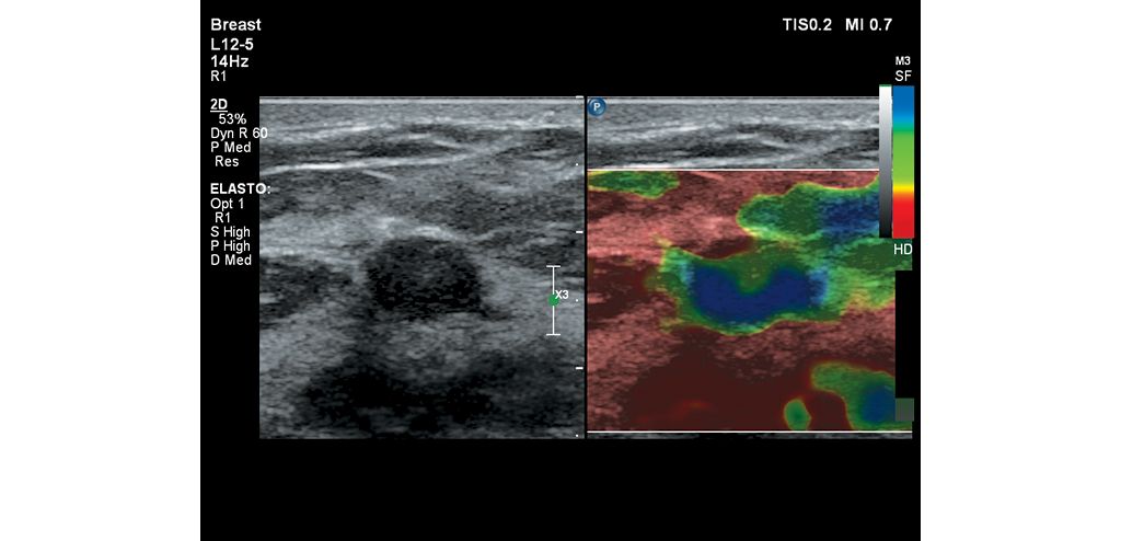 Strain elastography of the breast image from the Affiniti 70