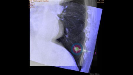 Mise à jour de la planification d’une ablation interactive