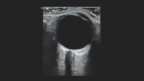 Optic nerve
