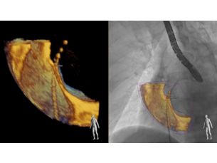 EchoNavigator Live echo and live X-ray fusion tool