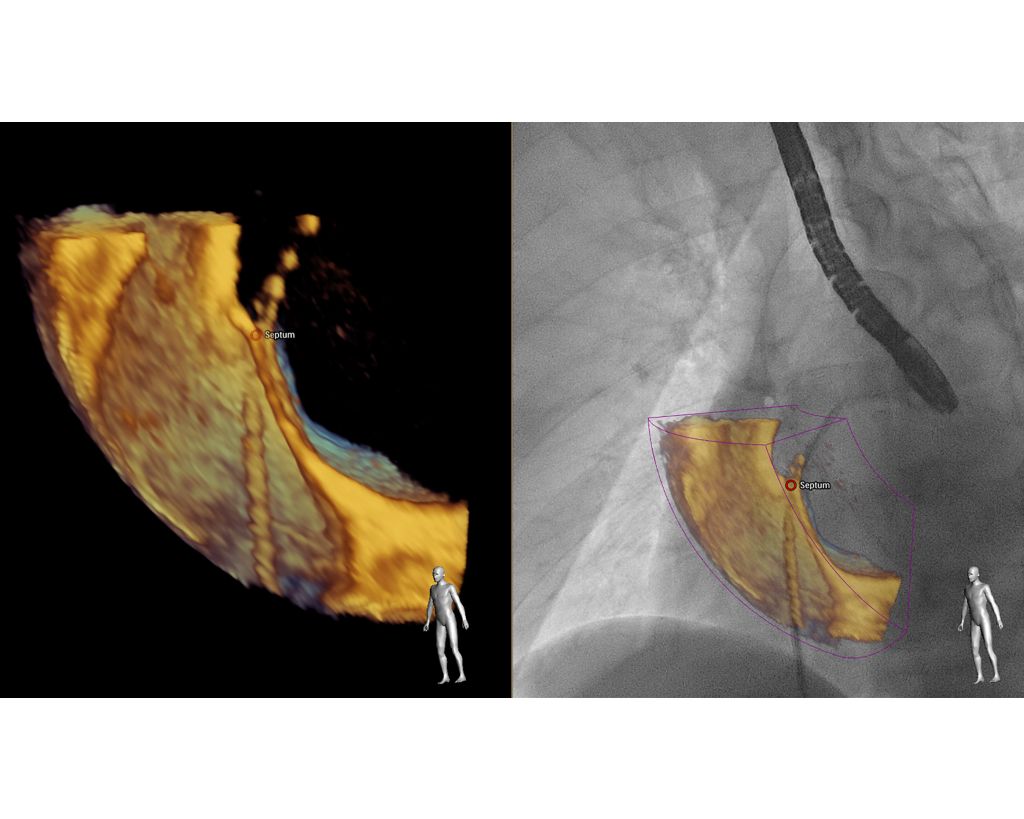 EchoNavigator Live echo and live X-ray fusion tool
