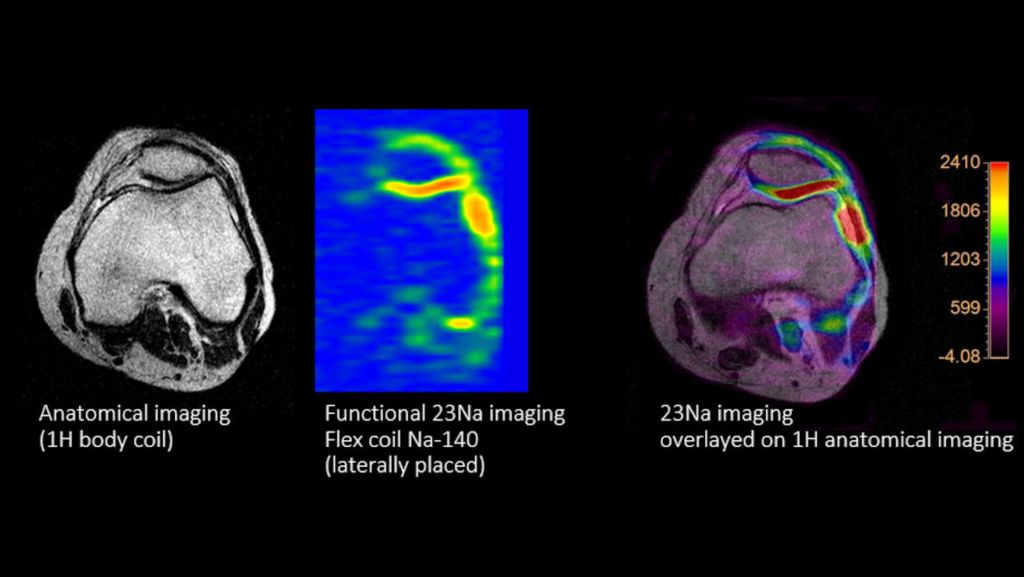 Multi Nuclei Knee exam 1H and 23Na