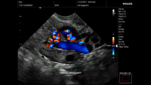 Innosight clinical image adnexal vascularity