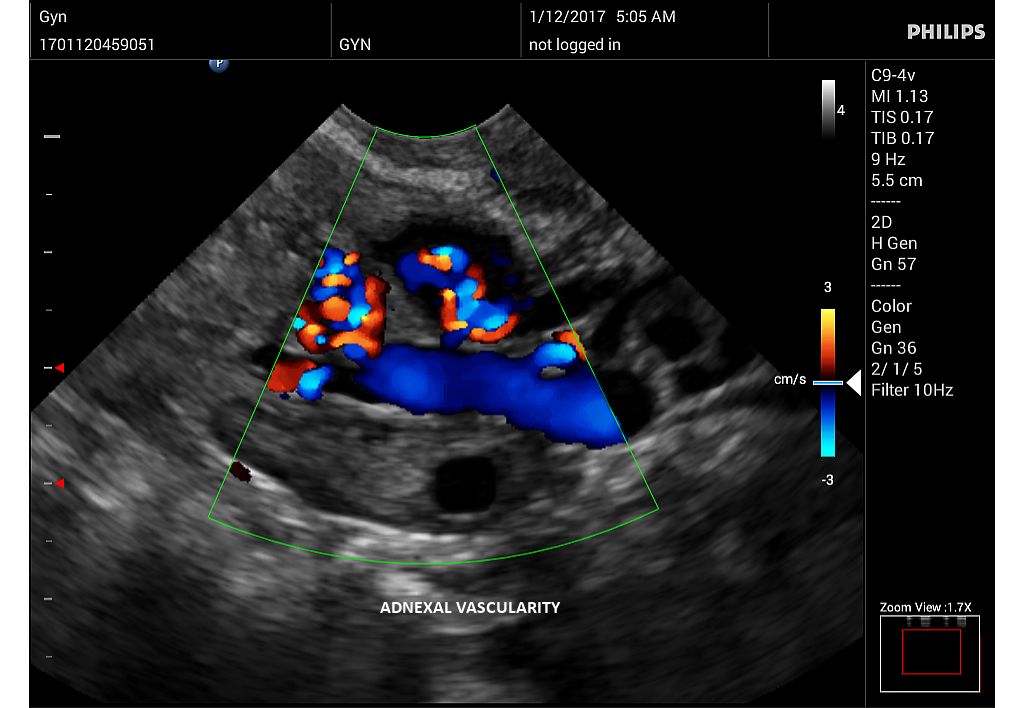 Innosight clinical image adnexal vascularity