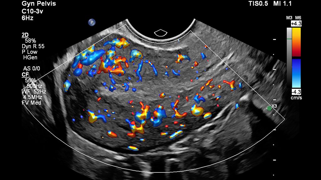 Clinical Color Flow image of uterus scanned with Flow Viewer on EPIQ Elite