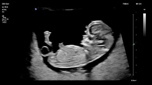 Fetal Profile -eL18-4