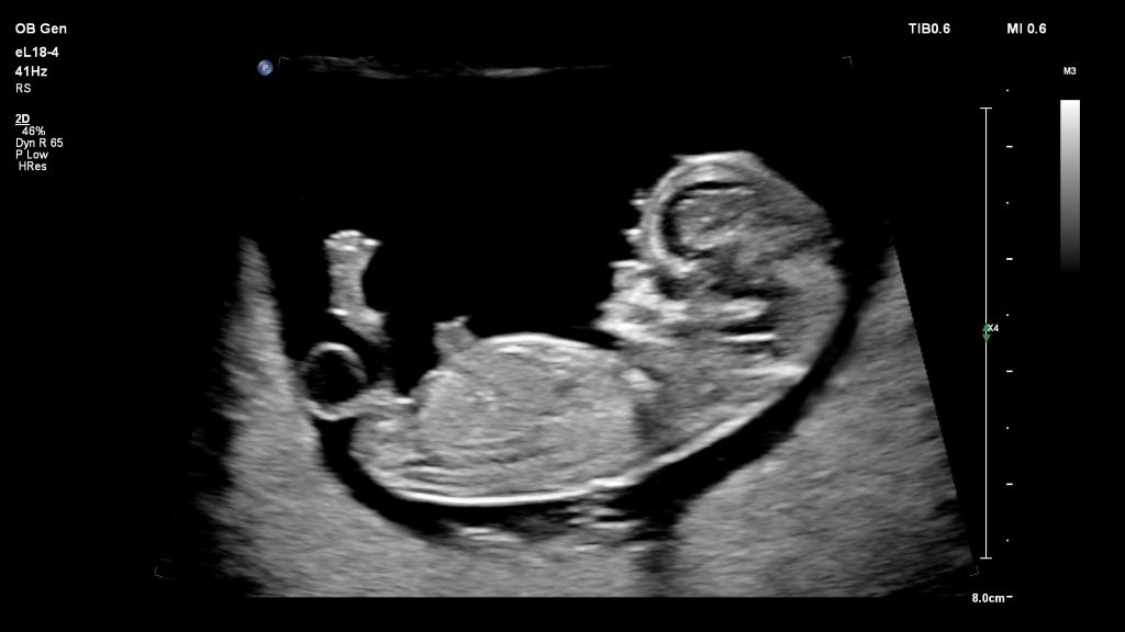 Fetal Profile -eL18-4