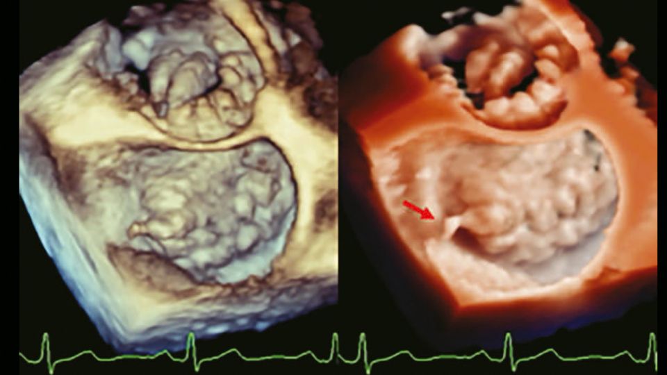 TrueVue - Enhanced visualization in diffuse degenerative mitral valve disease