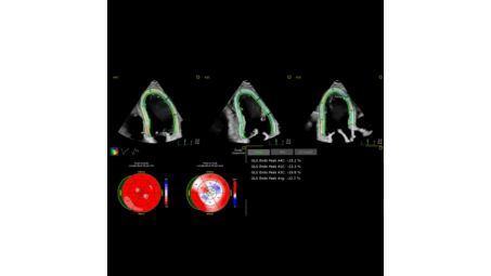 AutoStrain LV with automated EF and mid-layer strain