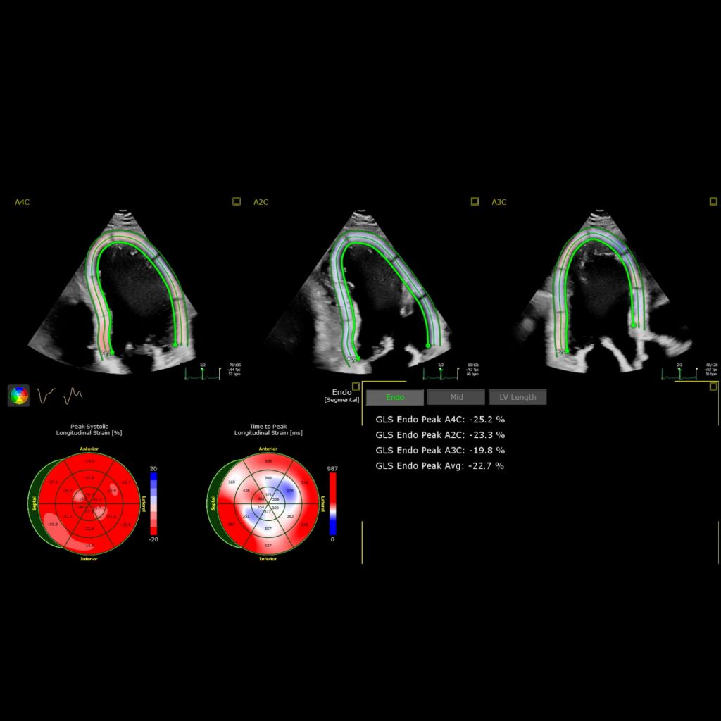 AutoStrain LV with automated EF and mid-layer strain