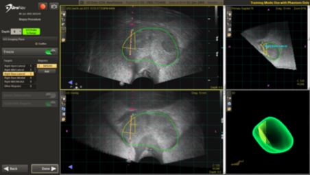 Biopsieführung mit UroNav – sogar ohne vor der Biopsie erfasste MR-Bilder