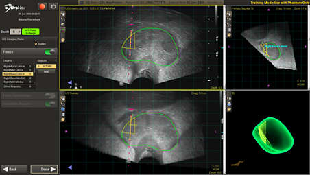 UroNav vous guide pendant la biopsie, même sans images IRM pré-biopsie