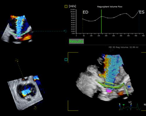 Heart function, echo AI application interface