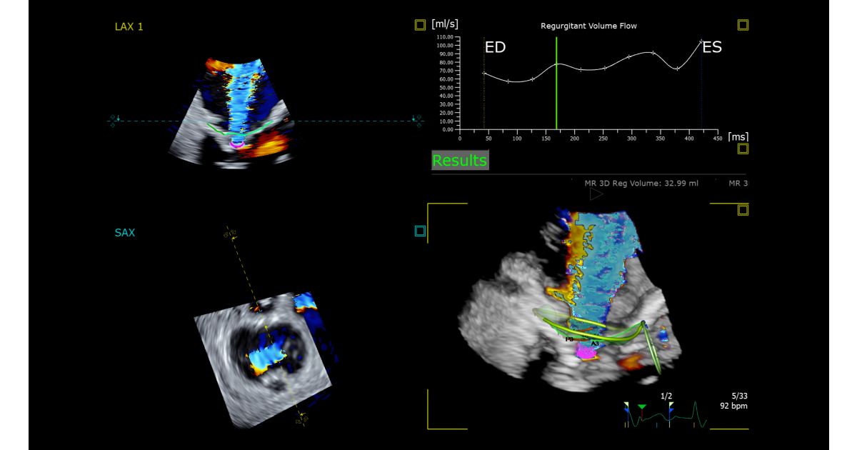 3D Auto Color Flow Quantification - Philips