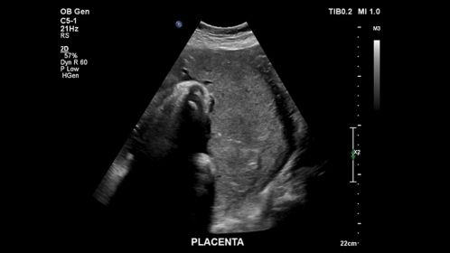 Placenta