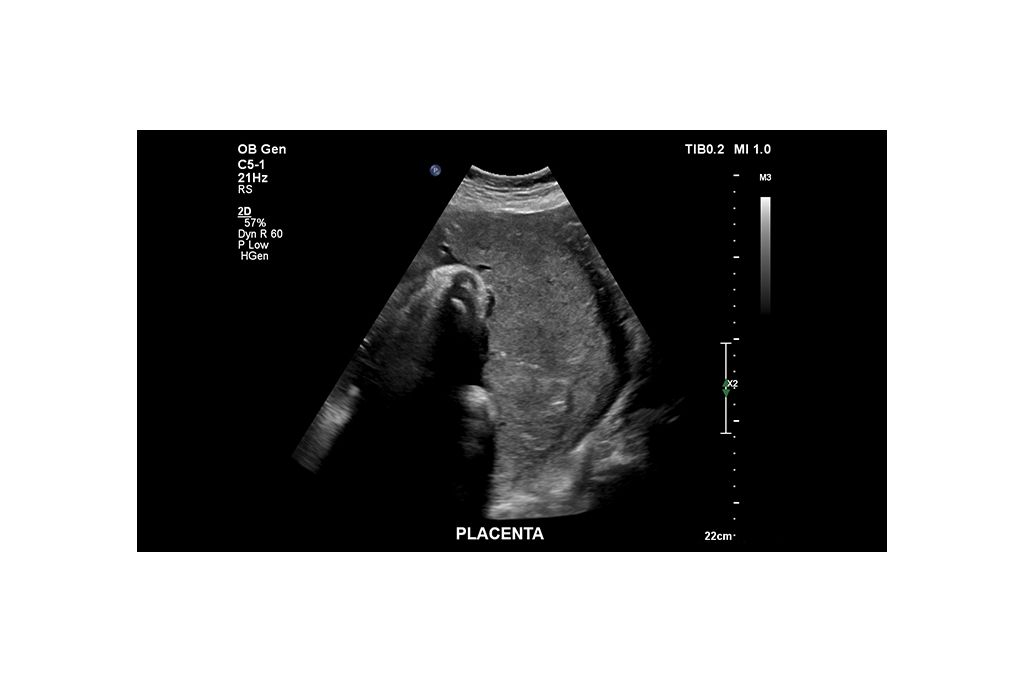 Placenta