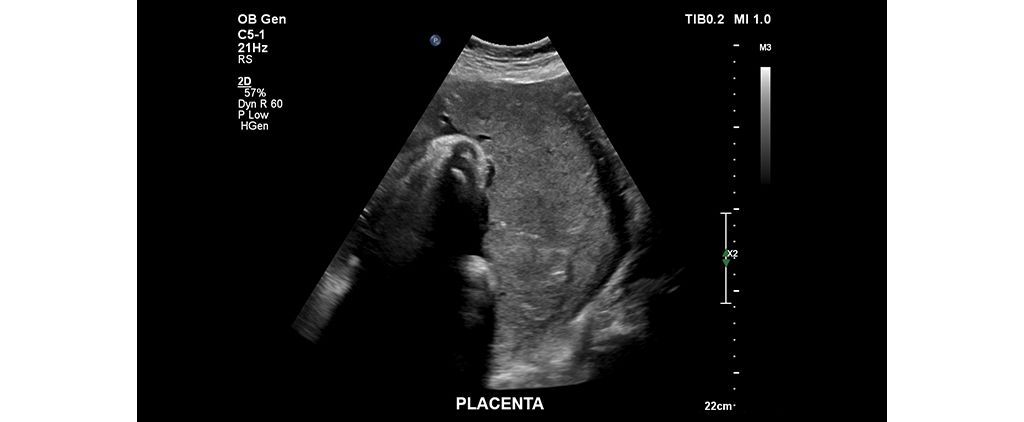 Placenta