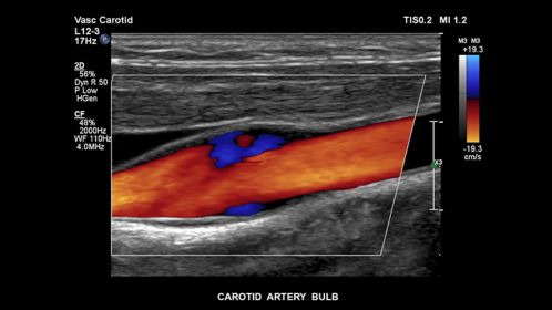 Carotid artery bulb