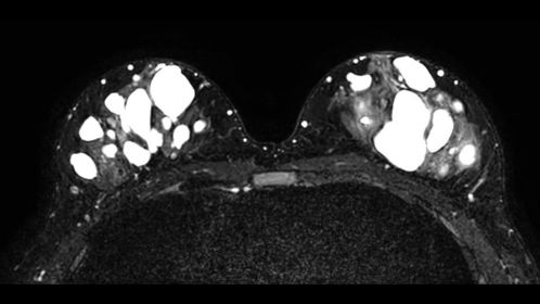 

BreastVIEW T2w TSE

