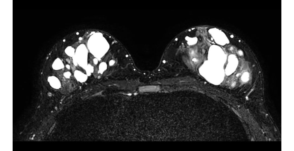 

BreastVIEW T2w TSE

