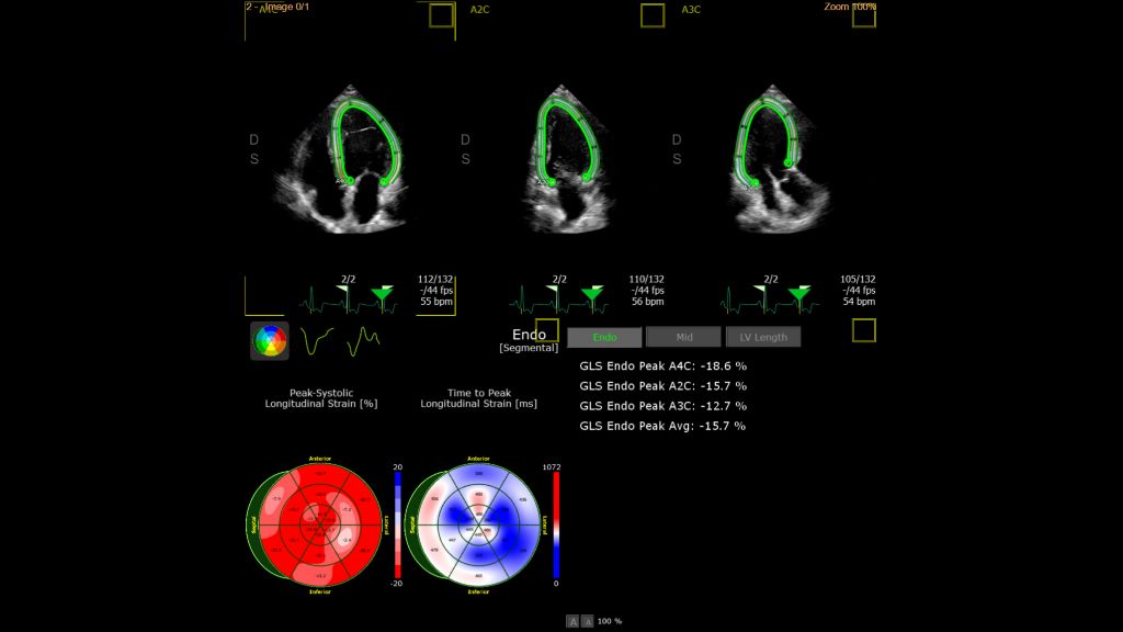 Adult echo demonstrating AutoStrain EF feature using S5-1 transducer.