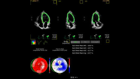 Adult echo demonstrating AutoStrain EF feature using S5-1 transducer.
