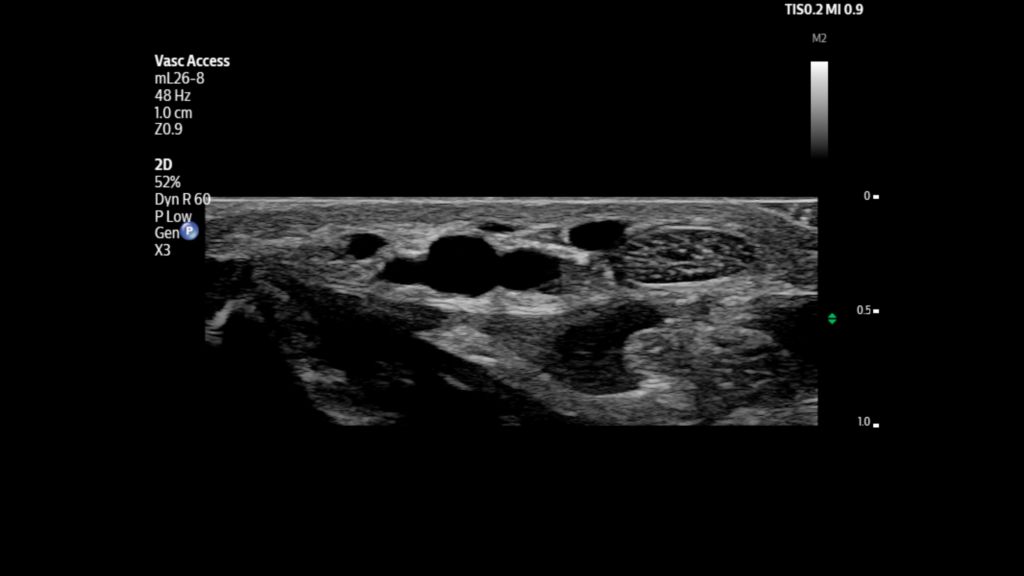Radial artery and veins shown using mL26-8 transducer on Flash 5100 POC.