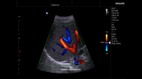 Innosight clinical image liver vasculature