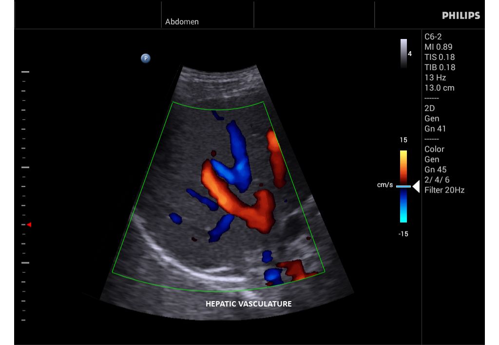 Innosight clinical image liver vasculature