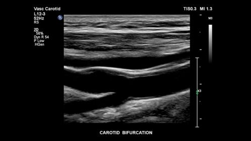 Carotid bifurcation