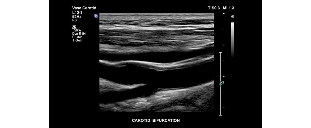 Carotid bifurcation