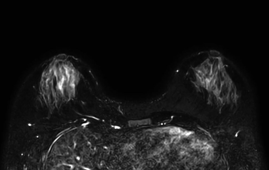 VISTA T2W TSE SPAIR Tra