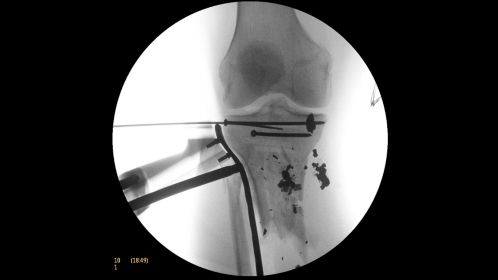 Clinical Image Philips BV Mobile C-arm Pulsera