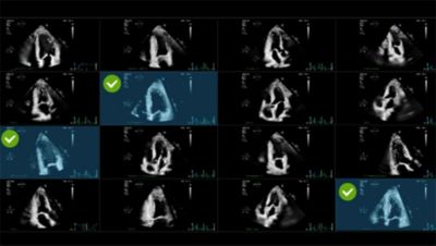Ultrasound AI Solutions