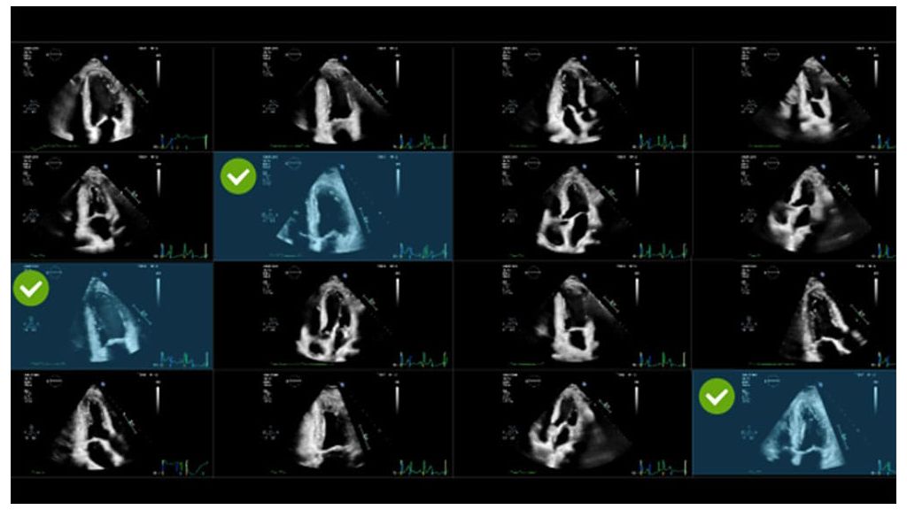 Smart View Select automatically selects the optimum images for 2D LV assessment