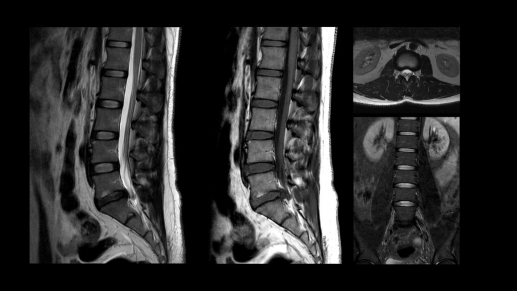 Lumbar Spine