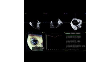 3D Auto Tricuspid Valve Quantification***