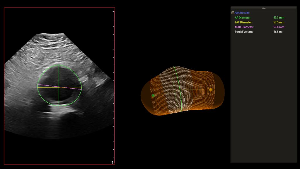 EPIQ X6-1_AAA Gallbladder Measurements 