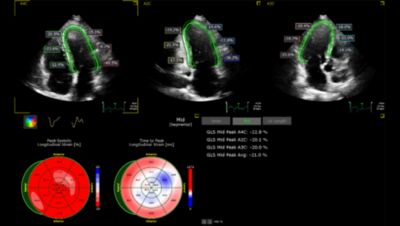 Ultrasound Workspace screen with strain image