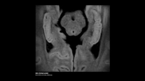 Hippocampus IRIS ZOOM b1000