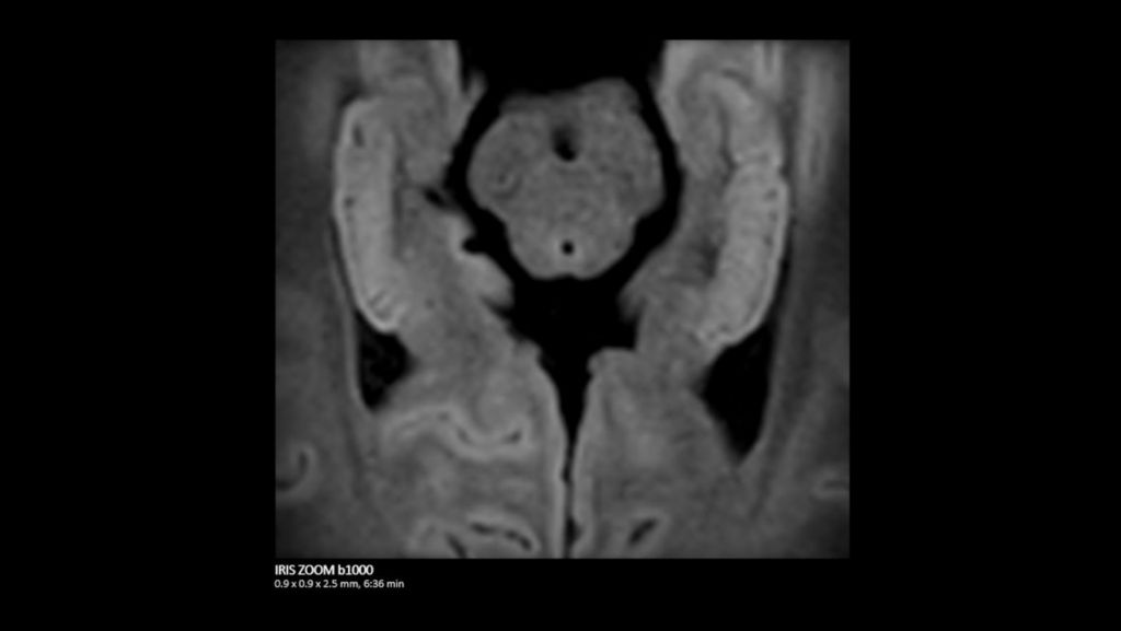 Hippocampus IRIS ZOOM b1000