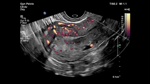 Gyn Pelvis ultrasound image shown with CPA using C9-4v transducer