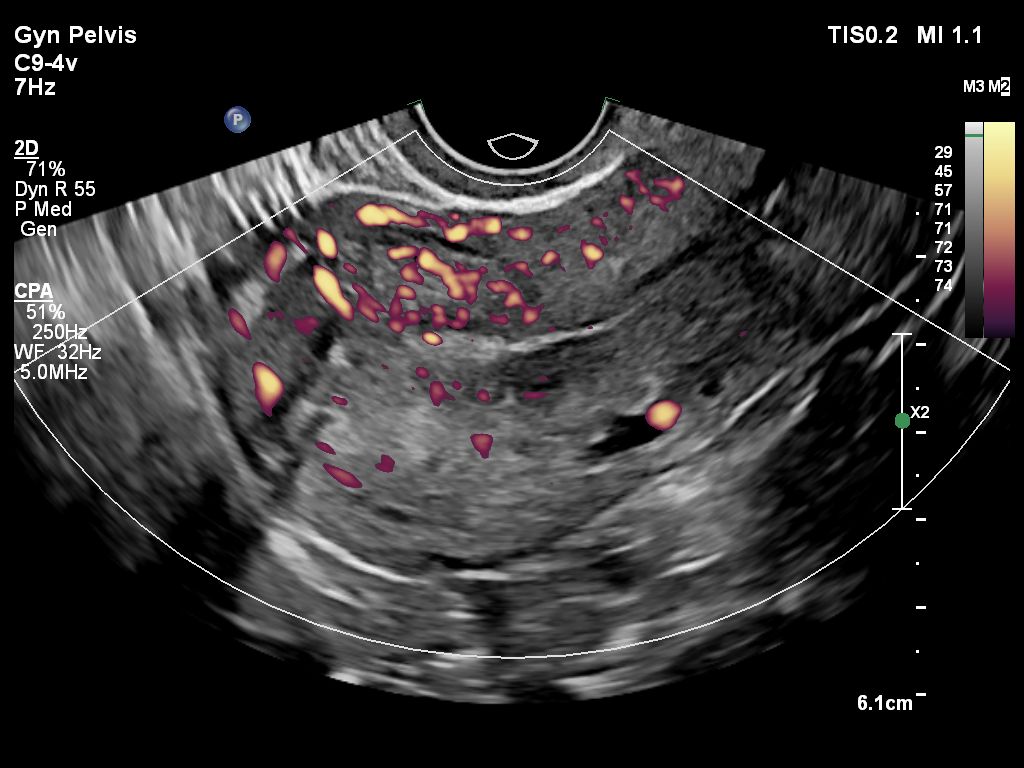 Gyn Pelvis ultrasound image shown with CPA using C9-4v transducer