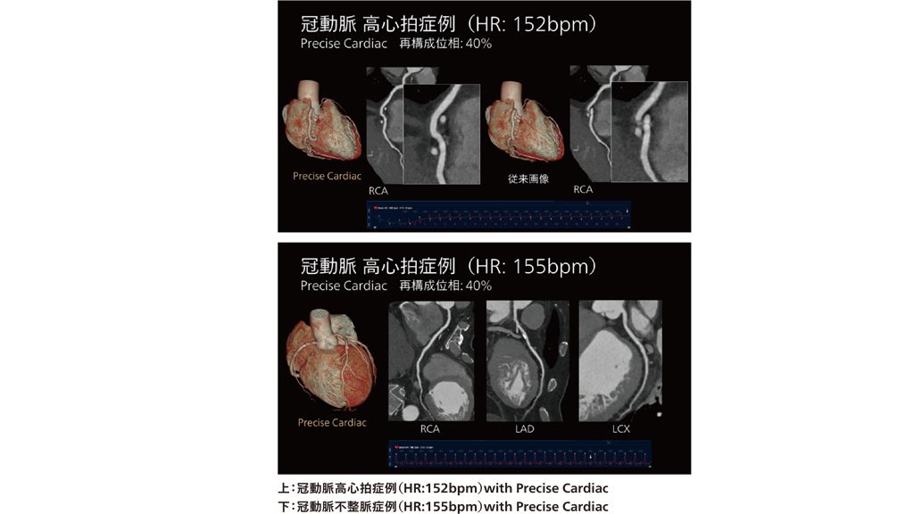 上：冠動脈高心拍症例（HR:152bpm）with Precise Cardiac
下：冠動脈不整脈症例（HR:155bpm）with Precise Cardiac