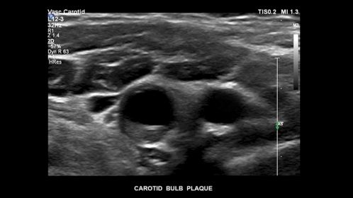 Carotid bulb plaque