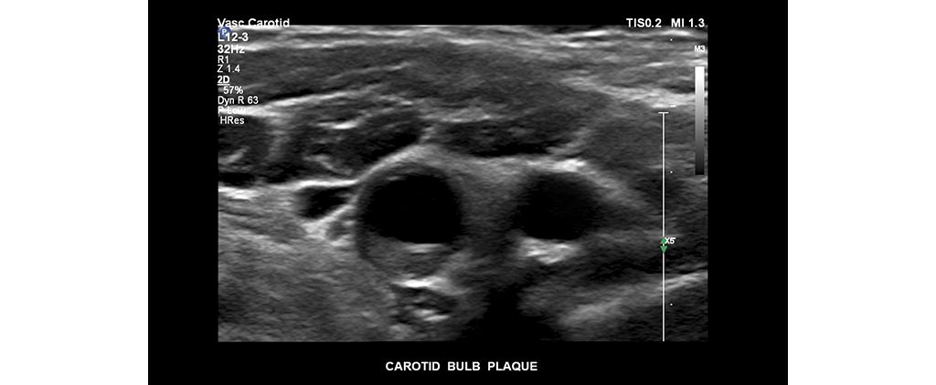 Carotid bulb plaque