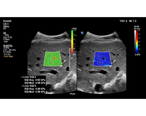 ElastQ shear wave elastography image