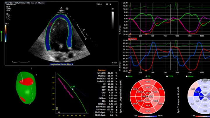 TomTec 2D Strain Analysis