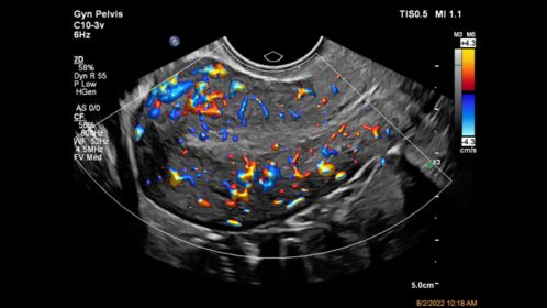 C10-3v Uterus Perfusion with Flow Viewer